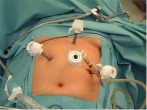 chirurgie digestive tunisie