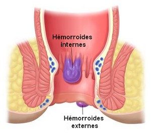 chirurgie-hemorroides-tunisie